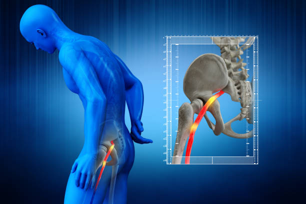 Pinched human sciatic nerve, anatomical vision. 3D Render. Pinched human sciatic nerve, anatomical vision. 3D Render.